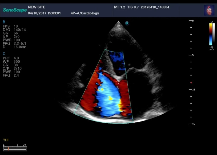 4. Трикуспидальная регургитация_result