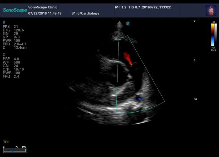 5. Клапан легочной артерии регургитация_result