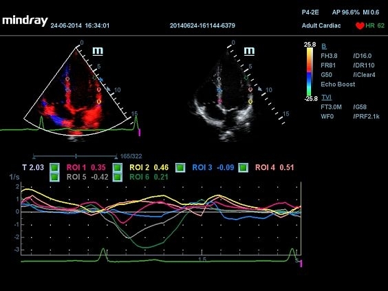 mindray-dc-70-pro-x-insight_1