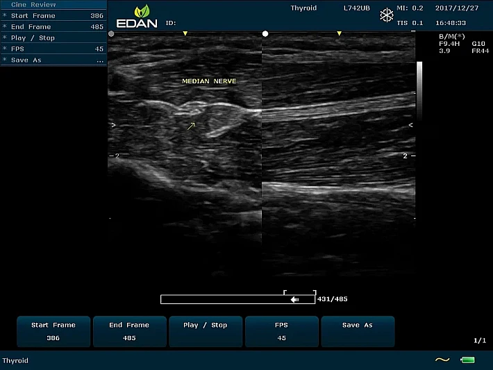 U60 L742UB nerve_result