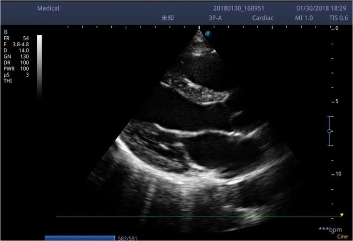 6. ЛЖ длинная ось_result