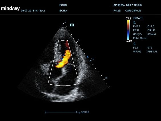 mindray-dc-70-pro-x-insight_5