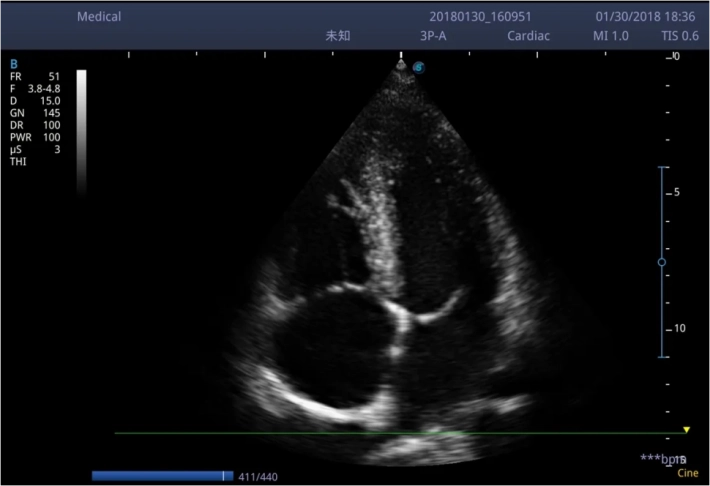 7. Апикальный доступ 4-камерная позиция_result