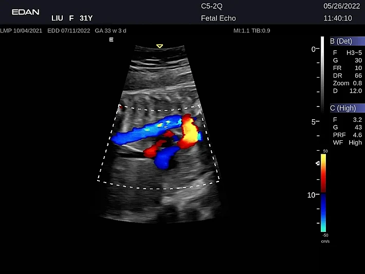 LX9 C5-2Q Fetal Echo_20220526 (1)_result