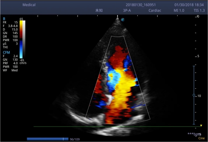 8. Апикальный доступ 4-камерная позиция ЦДК_result
