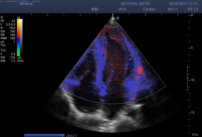 9. Цветовой тканевой допплер_result