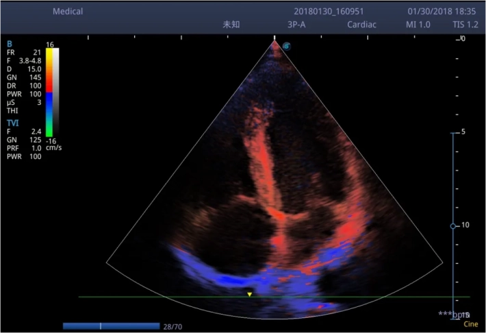 9. Цветовой тканевой допплер_1_result
