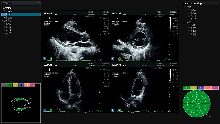 4. Stress Echo (3)_result