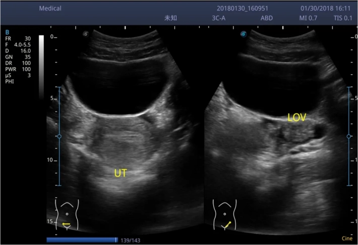 4. Матка_2B_result