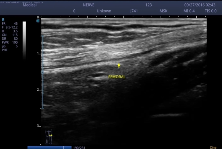 Бедренный нерв_result