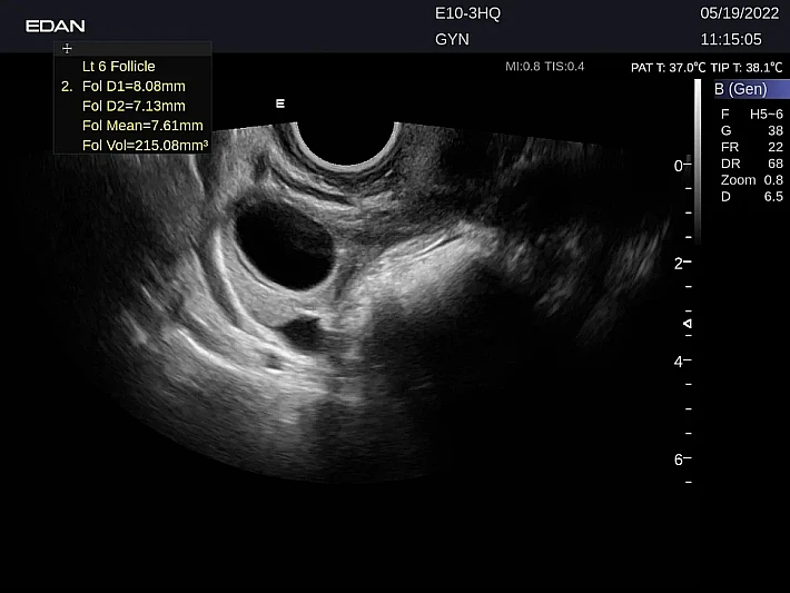 LX9 E10-3HQ Follicle_20220519 (5)_result