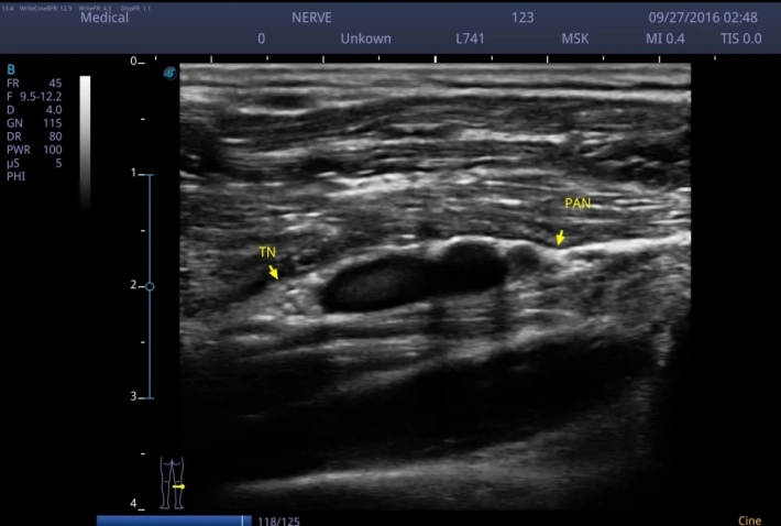 Большеберцовый нерв и общий малоберцовый нерв_result