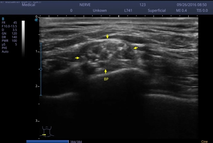 Надключичная часть плечевого сплетения_result