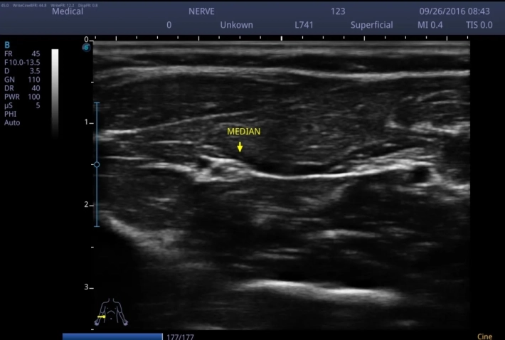 Срединный нерв_result