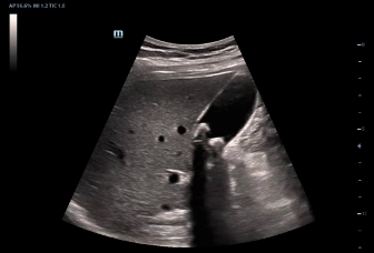 01-sc5-1e-gallbladder-stone-2d