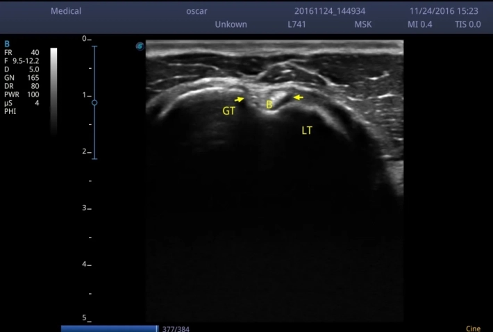 Сухожилие длинной головки бицепса_result