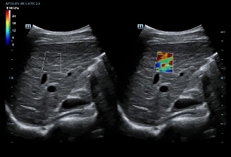 02-sc5-1e-liver-cirrhosis-ste