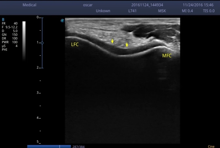 Хрящ локтевого сустава_result