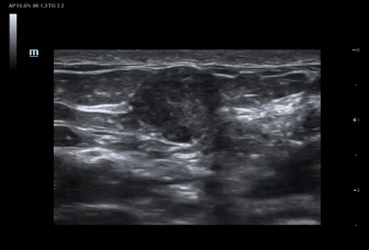 03-l12-3e-breast-lipomyoma-2d