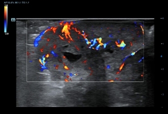 04-l14-5we-breast-cancer-color