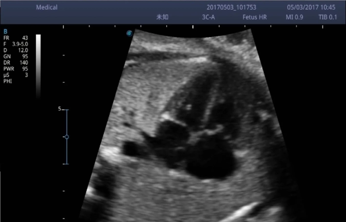 5. Сердце плода 4-х камерная позиция_result