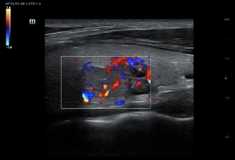05-l12-3e-thyroid-adenoma-color