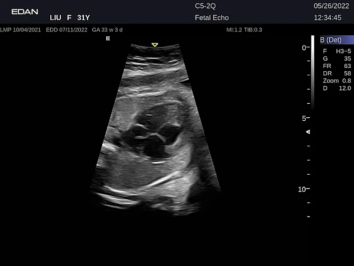 LX9 C5-2Q Fetal Echo_20220526 (2)_result