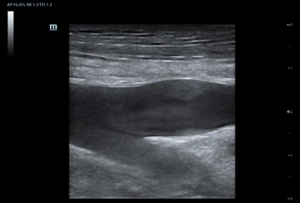 06-l12-3e-lower-ext-vein-varicosity-2d