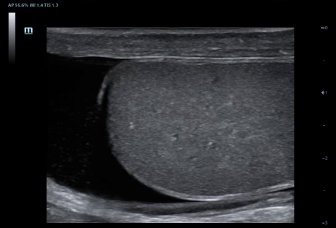 08-l12-3e-teaticle-hydrocele-testics-2d