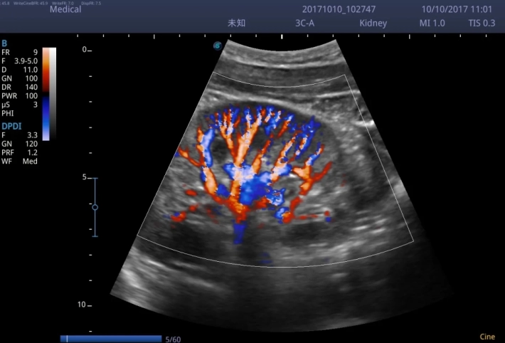 2. Направленный энергетический допплер с высоким пространственным разрешением SR Flow_result