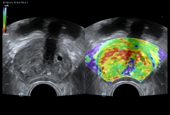 09-v11-3he-prostate-elasto