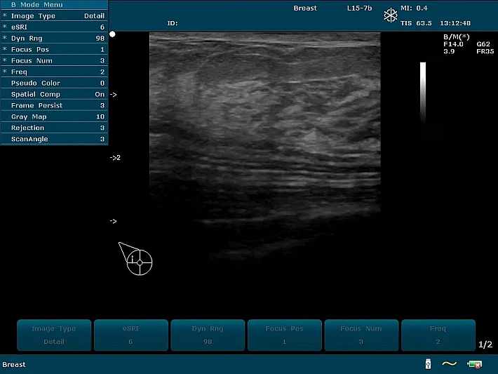 U2PE L15-7b Breast_result