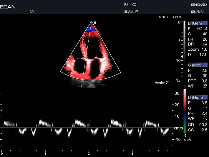 AX8  P5-1Cardiac TDI_result