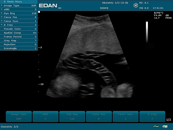 U2PE C5-2b Fetus (3)_result