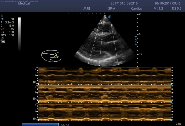10. Анатомический М-режим 3 курсора_result