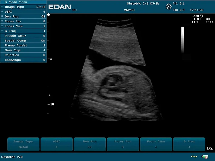 U2PE C5-2b Fetus (2)_result