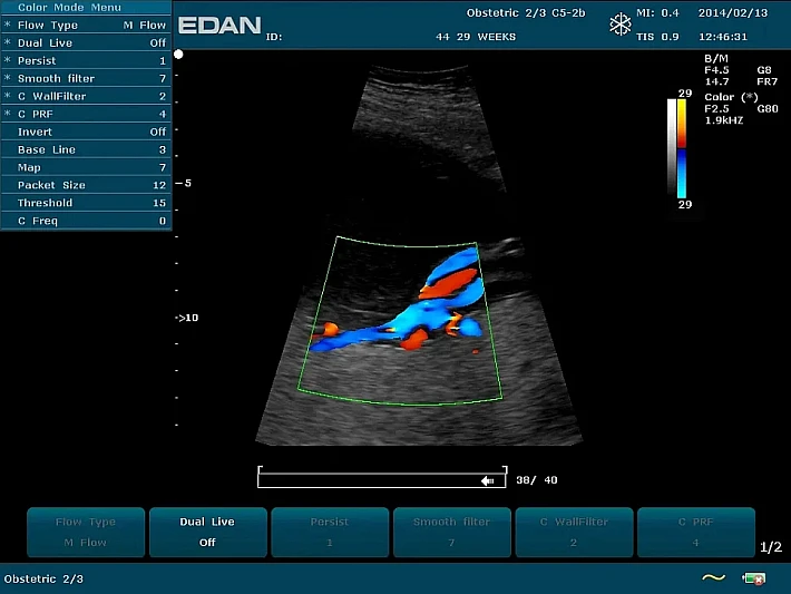 U2PE C5-2b Fetus (1)_result