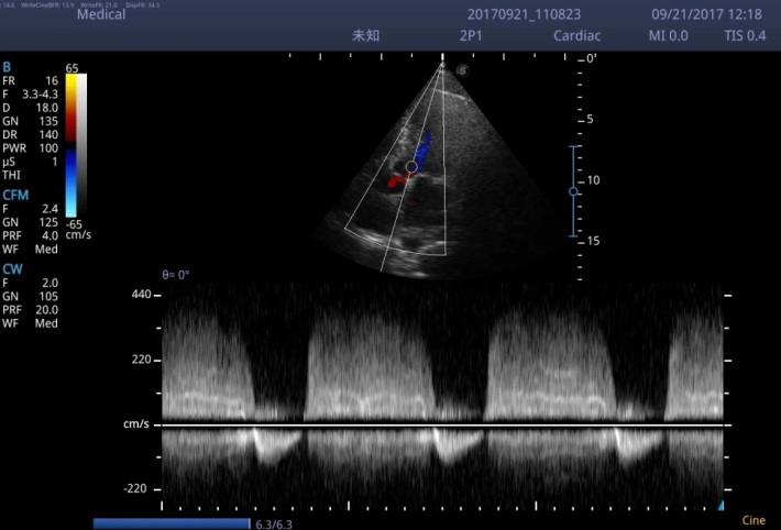 12. Аортальная регургитация_непрерывно-волновой допплер_result