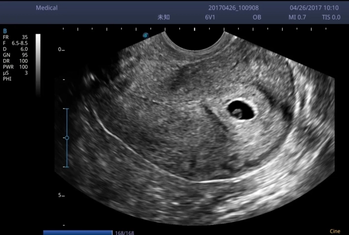 13. Ранний срок беременности_result