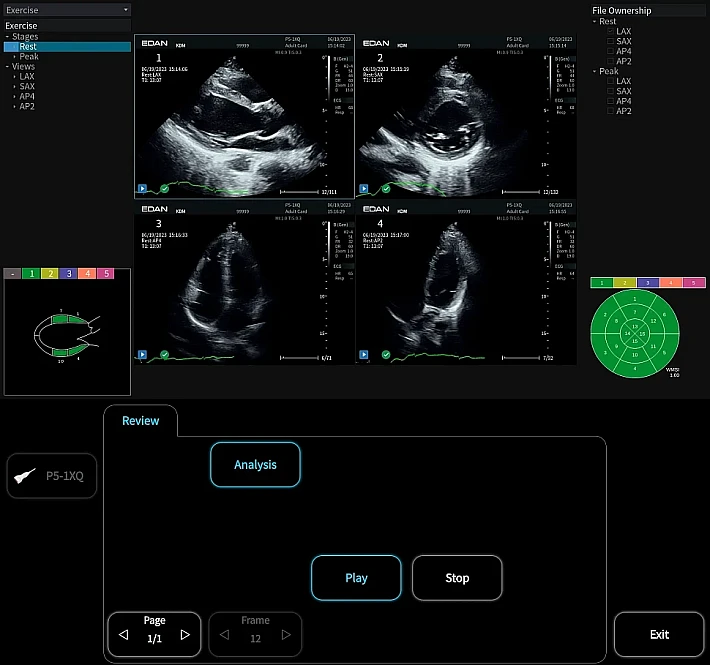 Stress Echo (1)_result