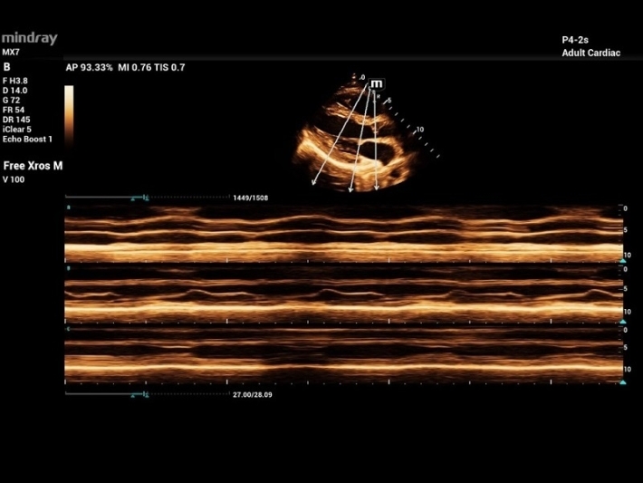 1Anatomical-M-Mode
