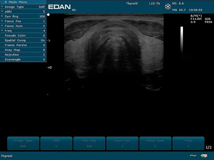 U2PE L15-7b Thyroid  (3)_result