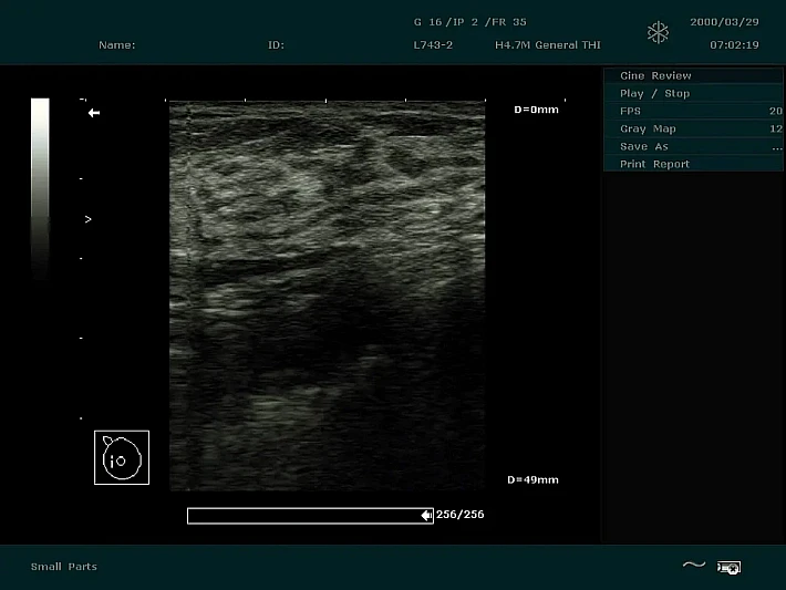 DUS60 L743-2 Breast_result