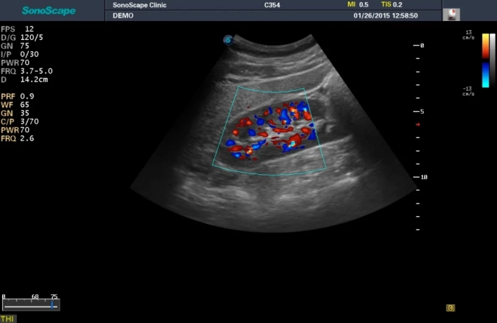 4. kidney_color_result