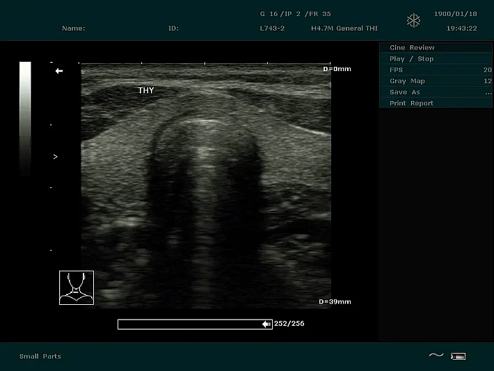 DUS60 L743-2 Thyroid_result