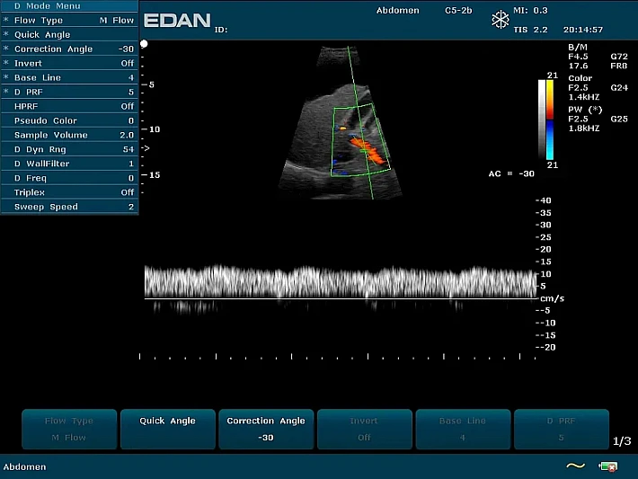U2PE C5-2b Liver ascites (1)_result