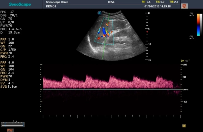 6. spleen artery_pw_result