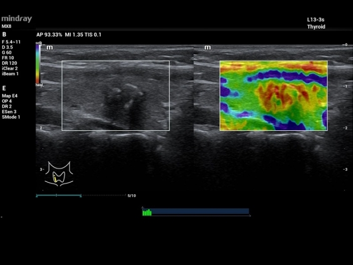 6Thyroid-Elastography