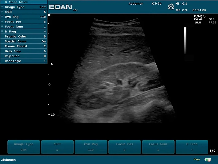 U2PE C5-2b Liver ascites (3)_result
