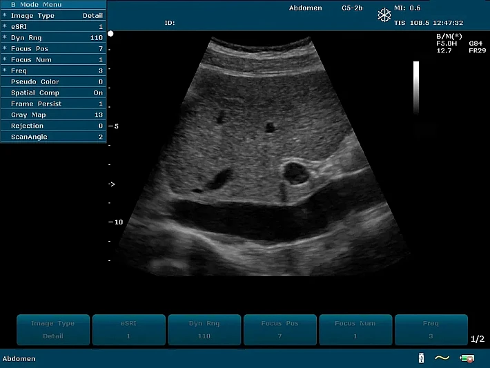 U2PE C5-2b Liver ascites (4)_result